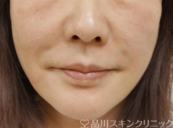 症例NO.38750のAFTER写真