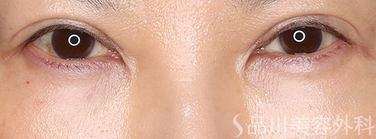 症例NO.75092のAFTER写真