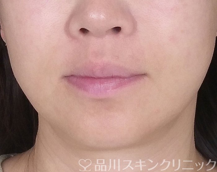 症例NO.69374のBEFORE写真