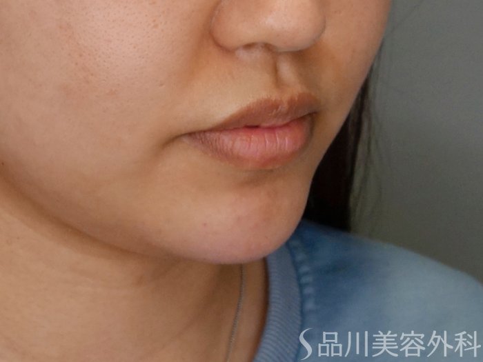 症例NO.69459のAFTER写真
