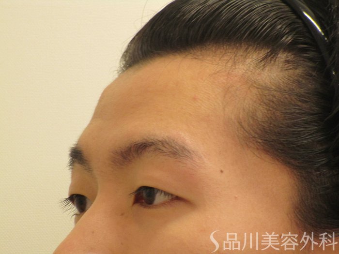 症例NO.65566のBEFORE写真