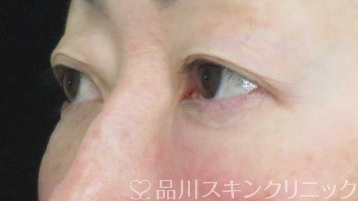 症例NO.65502のAFTER写真