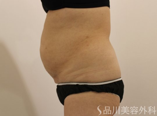 症例NO.72720のBEFORE写真