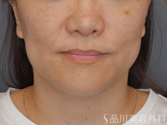 症例NO.72619のBEFORE写真