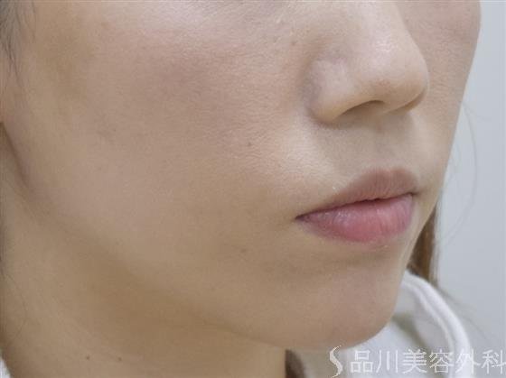 症例NO.47340のAFTER写真