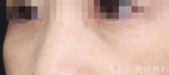 症例NO.61836のAFTER写真