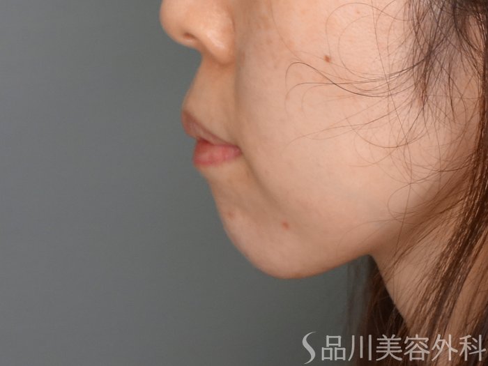 症例NO.70002のBEFORE写真
