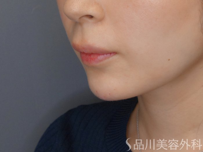 症例NO.70164のAFTER写真