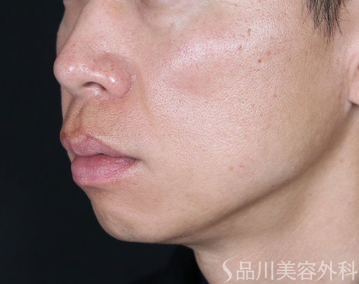 症例NO.73476のAFTER写真