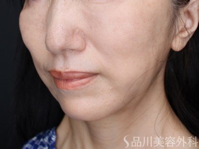 症例NO.65737のAFTER写真