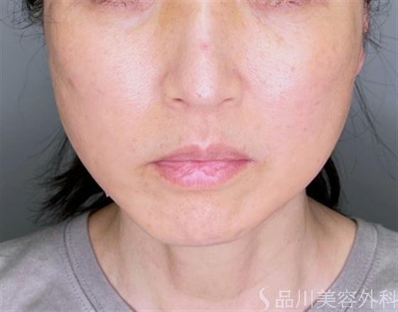 症例NO.51296のAFTER写真