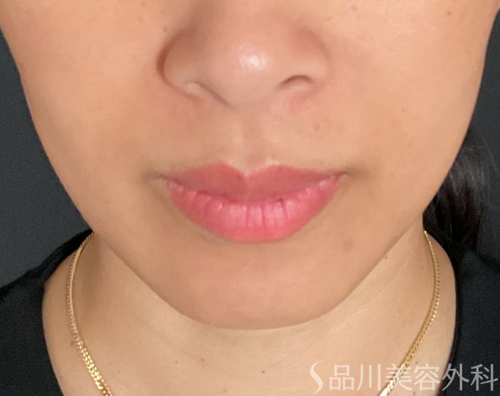 症例NO.74929のBEFORE写真