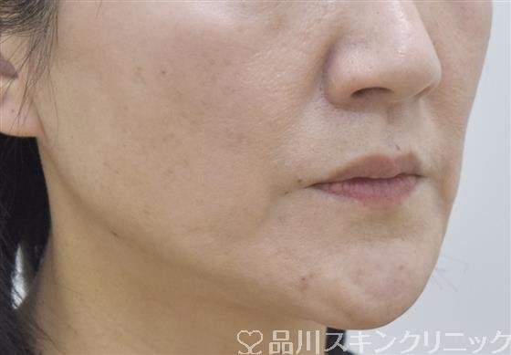 症例NO.53432のBEFORE写真