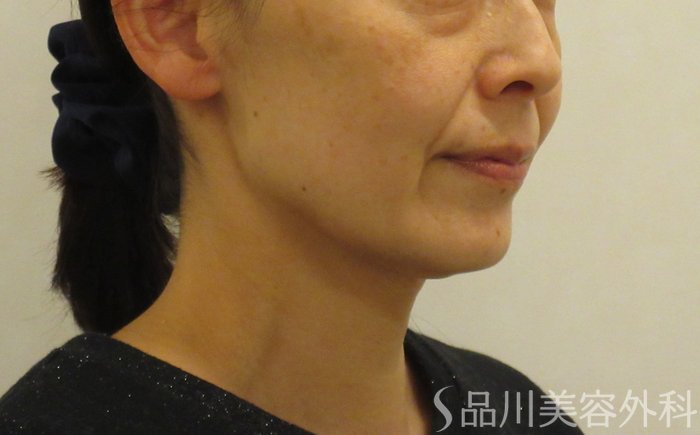 症例NO.72870のBEFORE写真