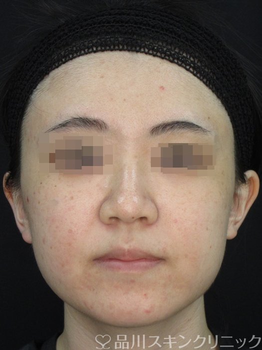 症例NO.73601のBEFORE写真