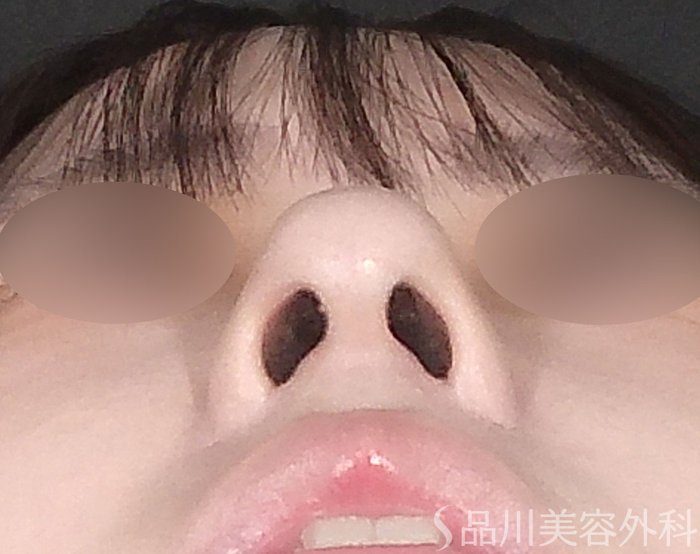 症例NO.71815のAFTER写真