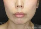 症例NO.71590のBEFORE写真