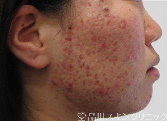 症例NO.42869のBEFORE写真