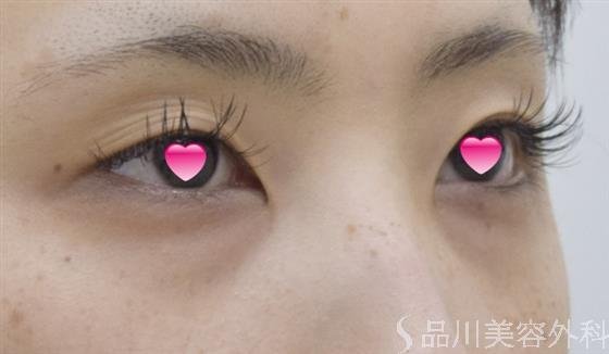 症例NO.51272のBEFORE写真