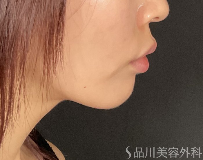 症例NO.75046のBEFORE写真