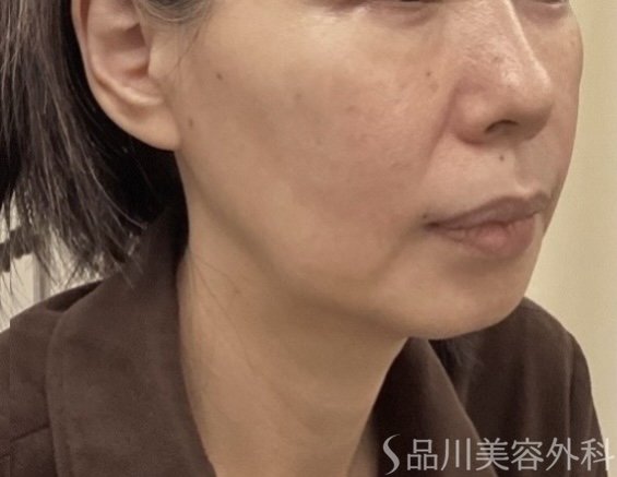 症例NO.75362のBEFORE写真