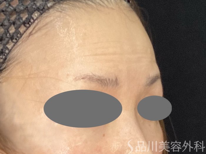 症例NO.72995のBEFORE写真