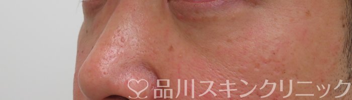 症例NO.65292のAFTER写真