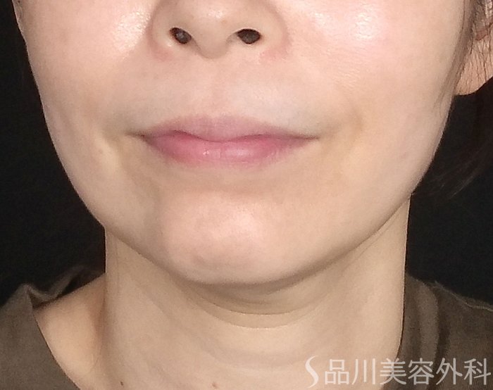 症例NO.70562のAFTER写真