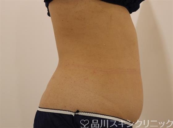 症例NO.40805のBEFORE写真