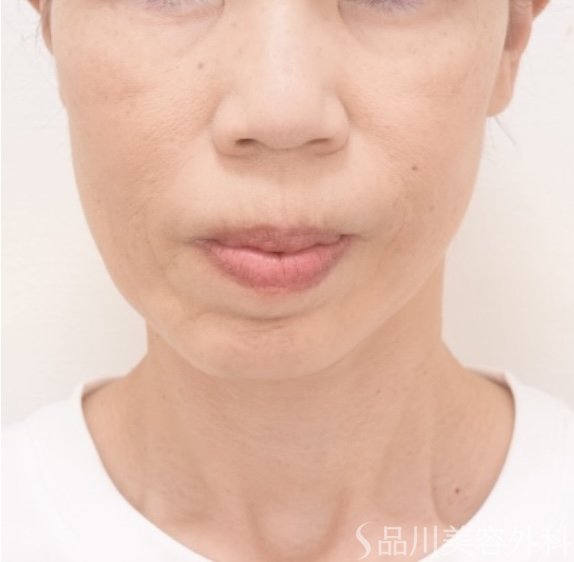 症例NO.72270のAFTER写真