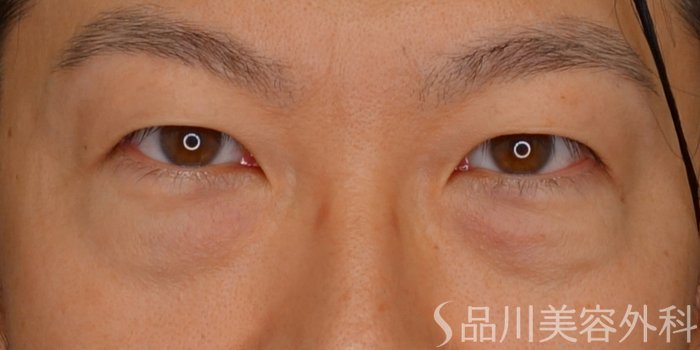 症例NO.73727のBEFORE写真