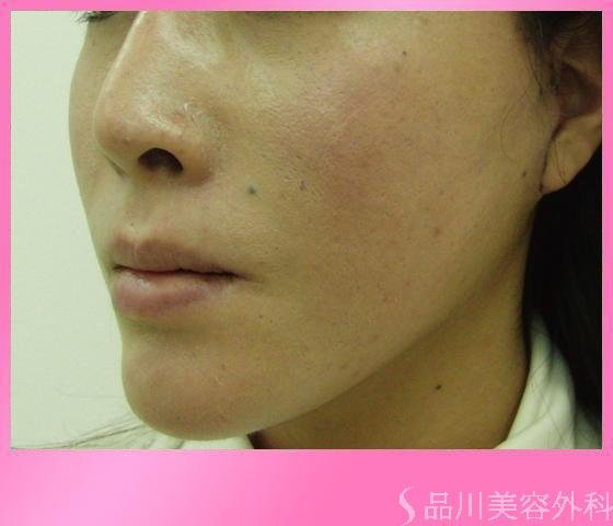症例NO.4086のAFTER写真