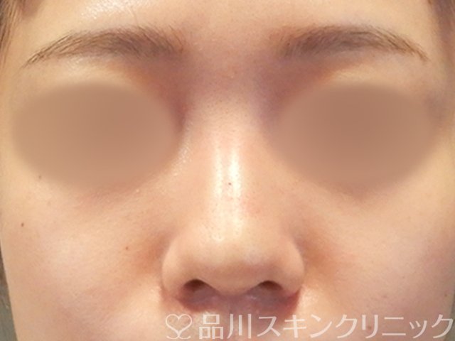 症例NO.65617のAFTER写真