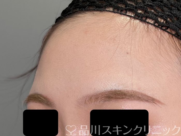 症例NO.70075のBEFORE写真