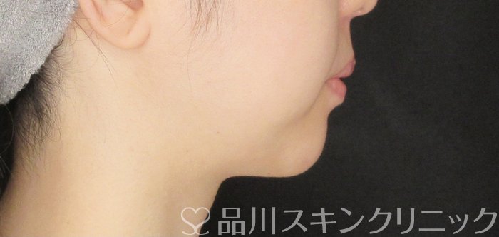 症例NO.69524のAFTER写真