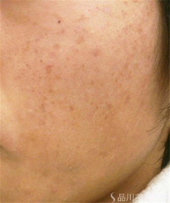 症例NO.18188のBEFORE写真