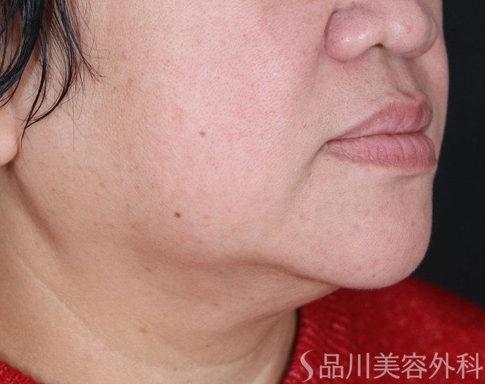 症例NO.73470のBEFORE写真