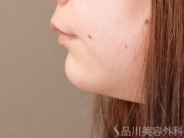 症例NO.70323のAFTER写真