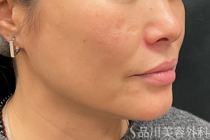 症例NO.73320のBEFORE写真