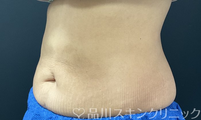 症例NO.74641のAFTER写真