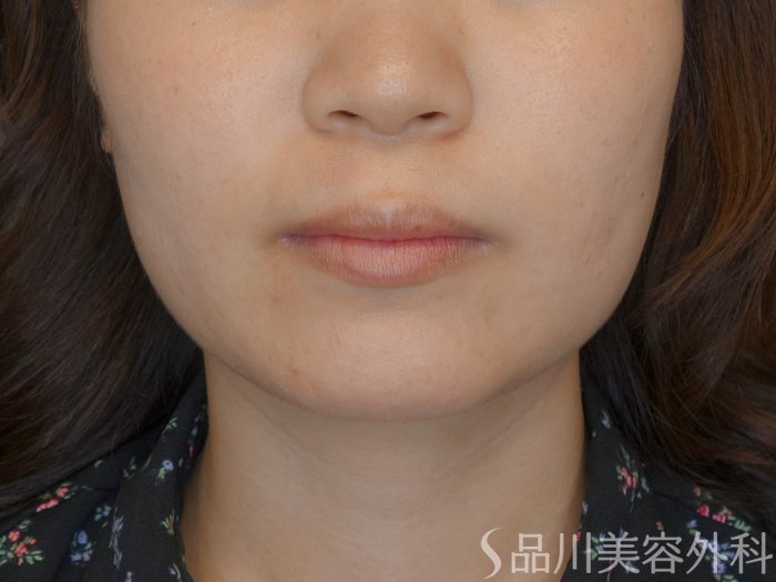 症例NO.70415のAFTER写真