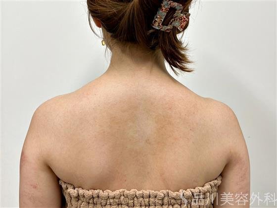 症例NO.55045のBEFORE写真