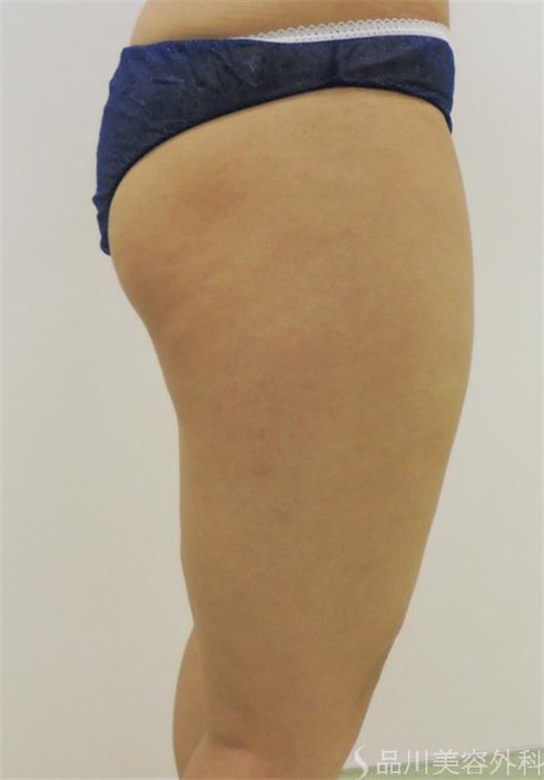 症例NO.23696のBEFORE写真