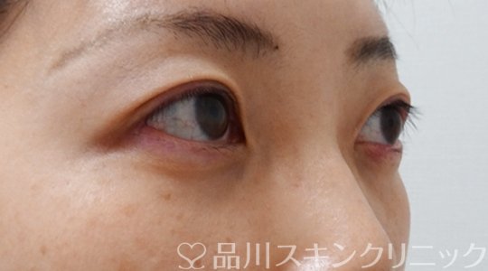 症例NO.70672のAFTER写真