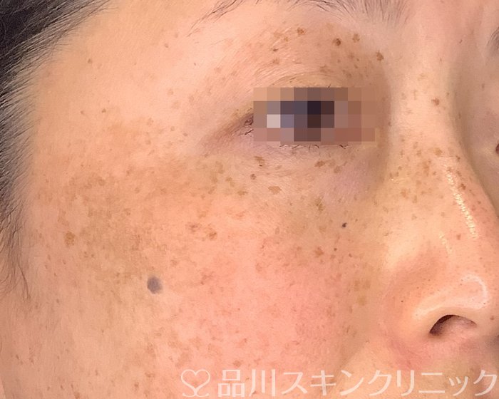 症例NO.70878のBEFORE写真