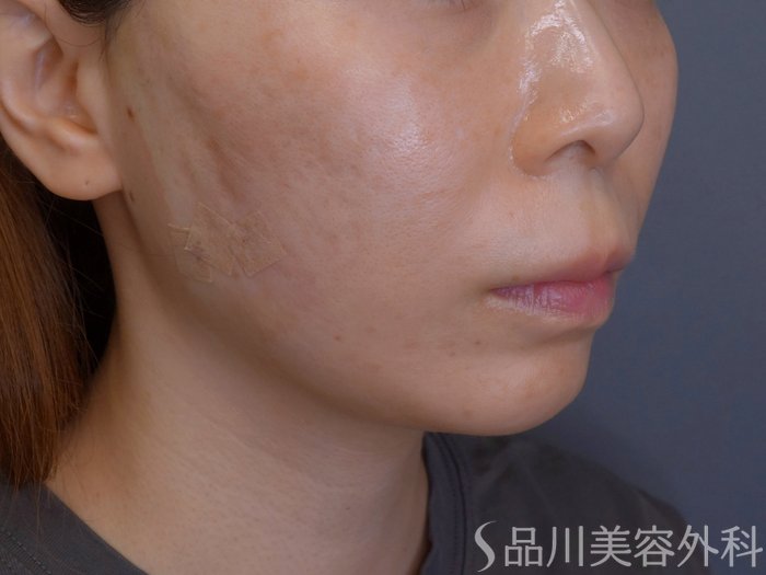 症例NO.74104のAFTER写真