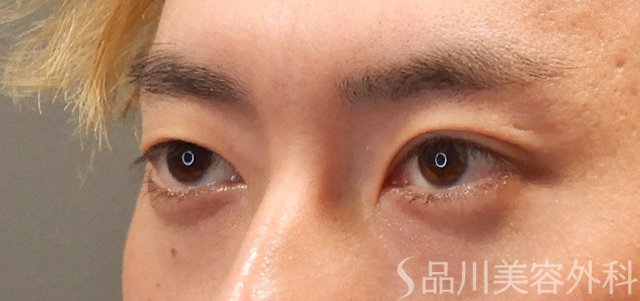 症例NO.72151のBEFORE写真