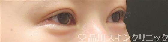 症例NO.59158のAFTER写真