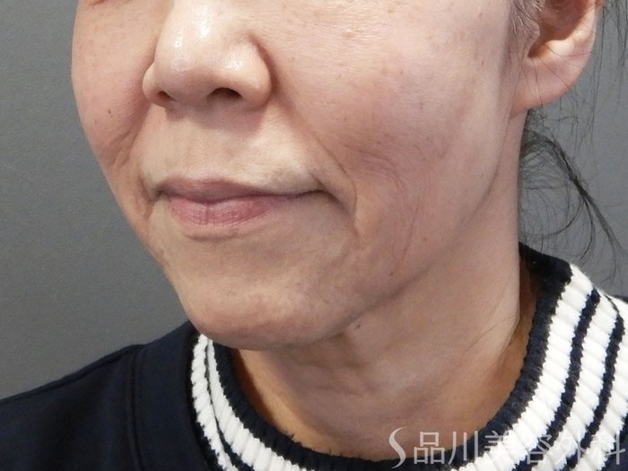 症例NO.74247のBEFORE写真