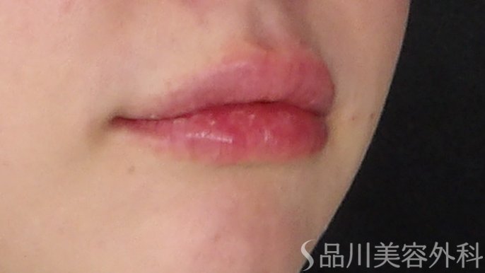 症例NO.67957のAFTER写真